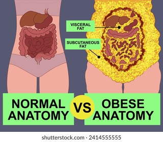 Normal anatomy vs obese anatomy. Body fat problems. Banner, snippet. Healthcare illustration. Vector illustration. 