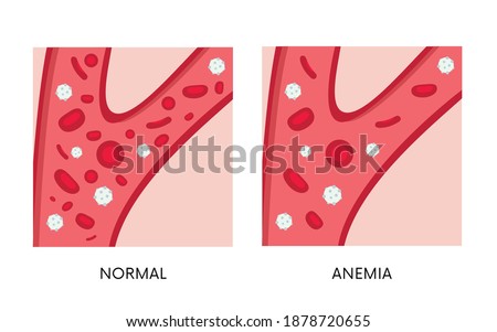 Normal and anemia amount of red blood cells in blood flat illustration. Iron deficiency anemia. Decrease in total amount of erythrocytes
or hemoglobin in blood. Health problem and treatment