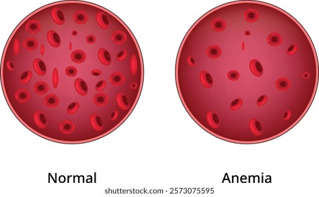 Normal Anemia Design Vector Illustration