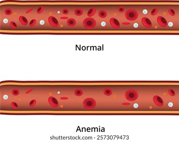 Normal Anemia Design Vector Illustration