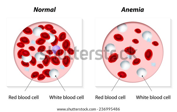 Normal Anemic Amount Red Blood Cells Stock Vector (Royalty Free) 236995486