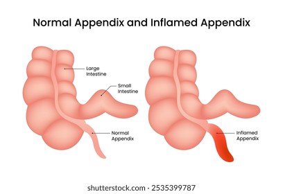 Apêndice normal e Apêndice inflamado