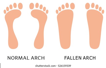 Normal arch versus fallen arch comparison, flat foot illustration on a white background