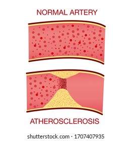 Normale Arterie. Die Akkumulation von Cholesterin in den Blutgefäßen. Atherosklerose.Vektorillustration, Illustration. Medizinischer Begriff