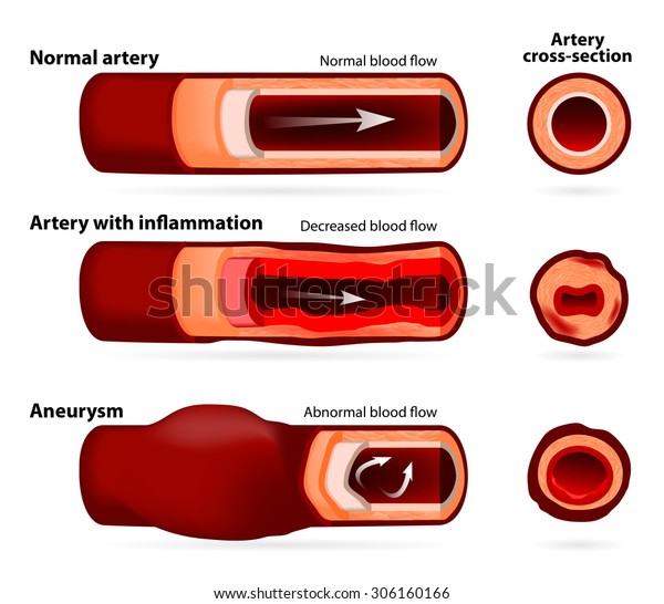 Normal Artery Inflamed Narrowed Artery Artery Stock Vector (Royalty ...