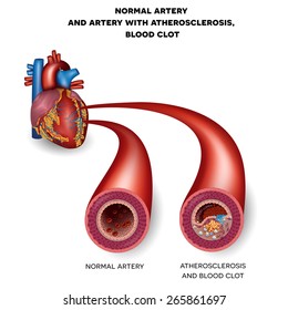Normal artery and unhealthy artery with blood clot. Plaque rupture detailed anatomy illustration. Artery lumen is narrowed and lead to thrombosis