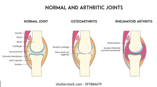 Normal and arthritic human joints. Types of arthritis. Minimal flat vector illustration for print or web