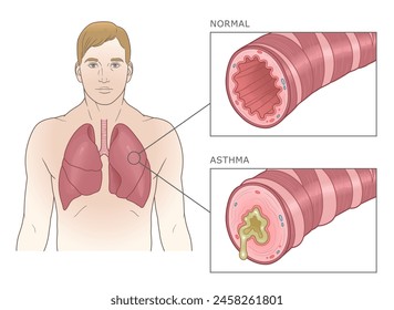 Normal and asthmatic bronchioles with man. Asthma medical vector  illustration.