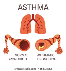 Normal and asthmatic bronchioles on white background. Asthma medical concept. Lungs symbol. Human body organs anatomy icon. Isolated vector illustration.