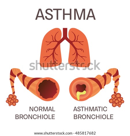 Normal and asthmatic bronchioles on white background. Asthma medical concept. Lungs symbol. Human body organs anatomy icon. Isolated vector illustration.