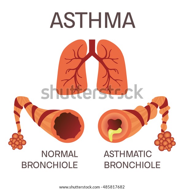 Normal Asthmatic Bronchioles On White Background Stock Vector (Royalty ...