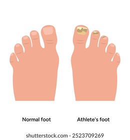 Normal and athletes foot. Fungus nails. Podiatrist disease 