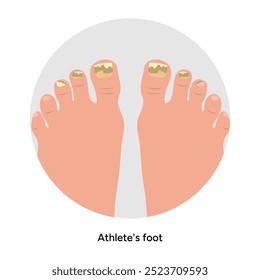 Normal and athletes foot. Fungus nails. Podiatrist disease 