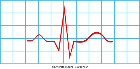 Normal Atrial And Ventricular Depolarization On Electrocardiogram