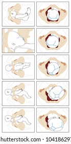 Normal birth showing detail of fetal movement during delivery through the birth canal