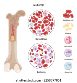 Sangre normal y sangre afectada por la enfermedad de la leucemia. Enfermedades peligrosas, cáncer de sangre. Tipos de células sanguíneas. Ilustración vectorial plana