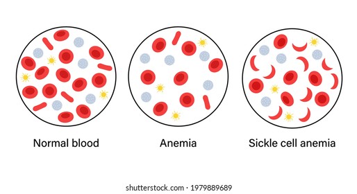 Normal Blood Anemia Specimen Sickle Anemia Stock Vector (Royalty Free ...