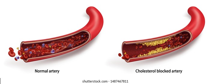 Normaler Blutfluss. Die Akkumulation von Cholesterin in den Blutgefäßen. Atherosklerotische Plaque. Vektorgrafik 3D. Medizinisches Poster.