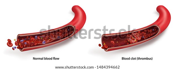 正常な血流 血栓 血栓 白い透明な背景にベクター画像3dイラスト のベクター画像素材 ロイヤリティフリー