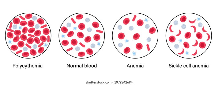 142 Polycythemia Images, Stock Photos & Vectors | Shutterstock