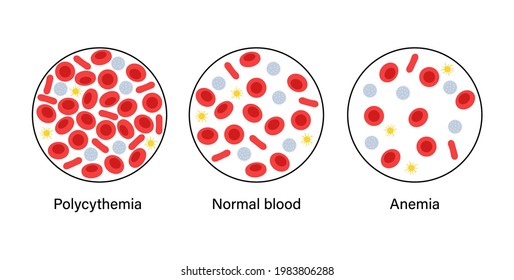 Normal Blood, Polycythemia And Specimen With Anemia Disease. Human Blood Cells Structure. Thrombocytes, Leukocytes And Erythrocytes Under Microscope. Microbiology Test Vector Illustration For Clinic