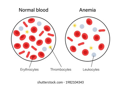 Normal Blood Specimen Anemia Disease Human Stock Vector (Royalty Free ...