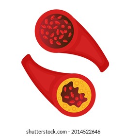 Normal blood vessel versus artery with cholesterol plaque buildup. Narrowed blood vein blocked with a clot. High cholesterol level as atherosclerotic risk. Medical concept. Vector illustration.