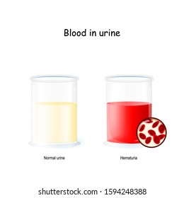 Blood in urine female