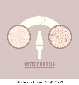 Normal bone after mass loss process caused by osteoporosis.  Close-up of normal femur cavity tissue and osteoporotic texture. Skeletal system disease. Senior osteopathy medical vector illustration.