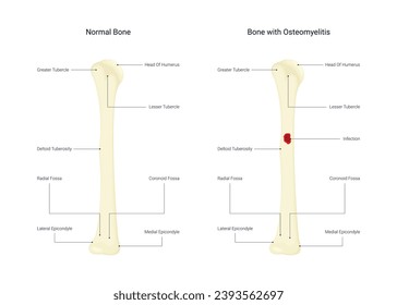 Normal Bone and Bone with osteomyelitis
