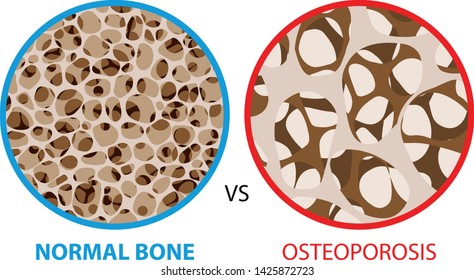 Normal bone versus osteoporosis, Bone spongy structure vector illustration