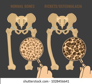 Normal bones versus Rickets and Osteomalacia. Medical, anatomy and biology concept. Educational vector illustration isolated on a dark grey background.