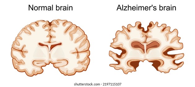 Normal Brain Alzheimers Brain Neurodegenerative Disease Stock Vector ...