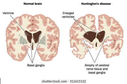 Normal brain and brain with Huntington's disease, showing enlarged ventricles and atrophy of nerve tissue and basal ganglia