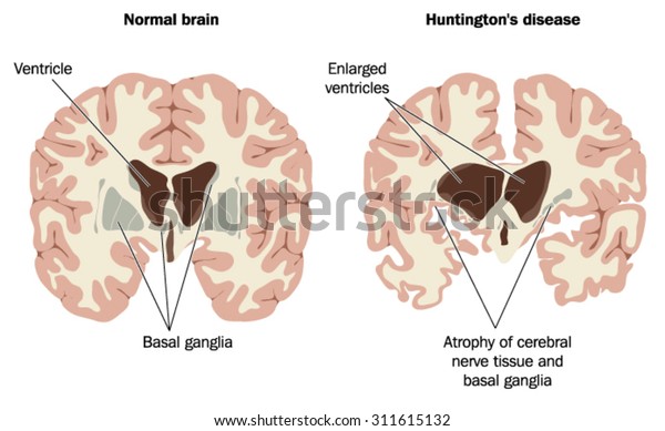 ハンチントン病を持つ正常な脳と脳で 脳室の肥大と神経組織と基礎神経節の萎縮を示す のベクター画像素材 ロイヤリティフリー