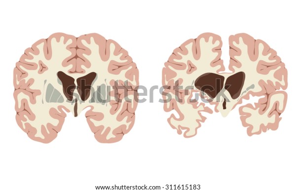 Normal Brain Brain Huntingtons Disease Showing Stock Vector (Royalty ...