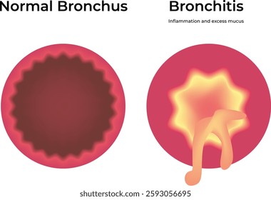 Normal Bronchus Bronchitis Science Design Vector Illustration Diagram