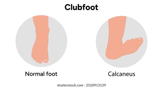 Normal e Calcaneus Clubfoot problema pé. Diagrama infográfico ortopédico