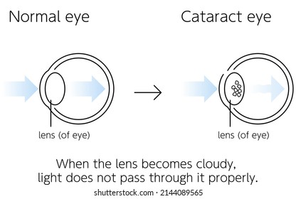 Normal and cataractous eye, illustration (line drawing)