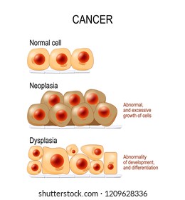 Normal cells, Dysplasia (abnormality of development, and differentiation), and Neoplasia (Abnormal, and excessive growth of cells). different. Vector diagram for educational, medical, biological use