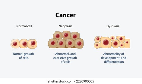 Normal cells, Dysplasia (abnormality of development, and differentiation), and Neoplasia (Abnormal, and excessive growth of cells). different. Vector diagram for educational, medical, biological and s