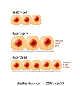 Normal cells, hypertrophy is an increase in cell size, hyperplasia results from an increase in cell number. different. Vector diagram for educational, medical, biological and science use