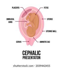 presentation cephalic of placenta