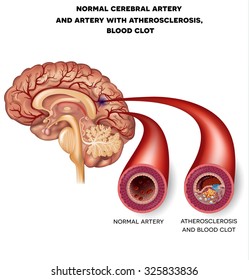 Normal cerebral artery and artery with atherosclerosis and blood clot.  Blocked blood flow by the thrombus. 