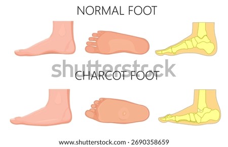 Normal and Charcot foot on a white bacground