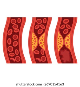 Ilustración vectorial arterial normal y colesterol bloqueado que muestra trombo de coágulo sanguíneo placa aterosclerótica trombosis venosa profunda TVP y bloqueo de la circulación