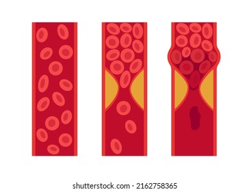 Normal And Cholesterol-blocked Artery. Blood Clot, Thrombus, Atherosclerotic Plaque. Deep Vein Thrombosis DVT Or Arterial Clot, Blood Vascular Flow. Blocked Circulation In Blood Vessel. Vector