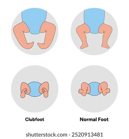 Pie normal y pie zambo con problemas en los niños. Diagrama de infografía ortopédica