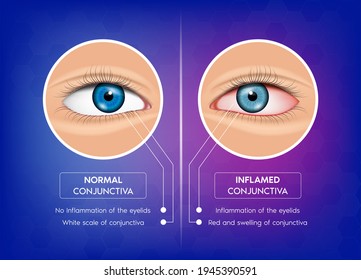 Normal conjunctiva and Conjunctivitis. Human eye anatomy in front view. 3D Vector EPS10 illustration