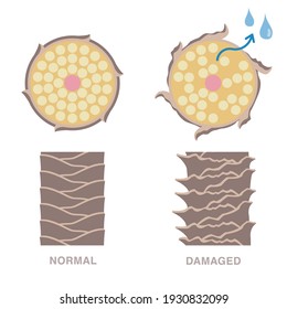 Normal And Damaged Hair. Damaged Hair Loses Moisture. Smooth And Damaged Cuticle. Vector Illustration.